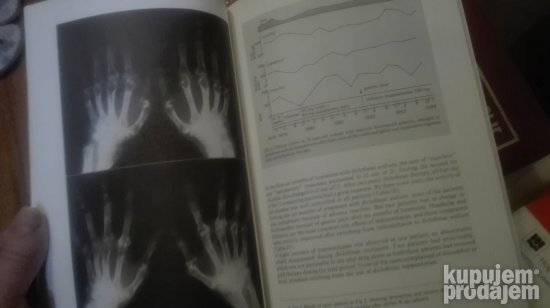 Further Experience With Voltaren