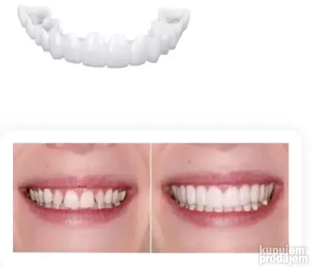 Moderna faseta za savršeno bele zube SNAP ON SMILE