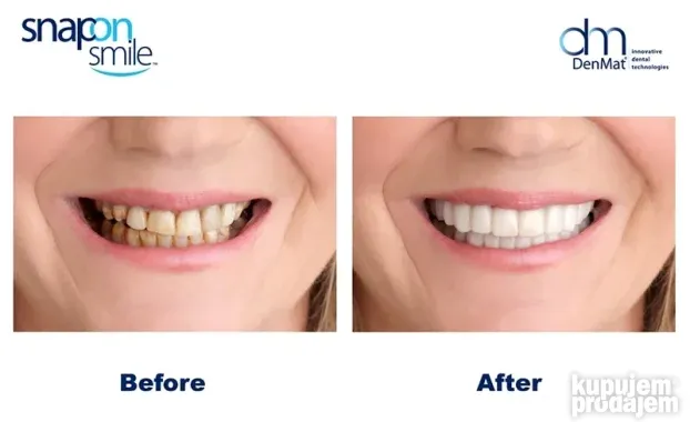 Moderna faseta za savršeno bele zube SNAP ON SMILE