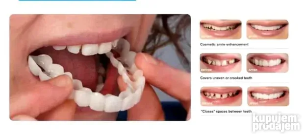 Moderna faseta za savršeno bele zube SNAP ON SMILE
