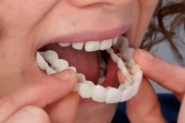 Moderna faseta za savršeno bele zube SNAP ON SMILE