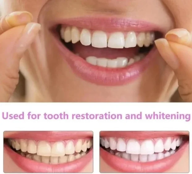 Moderna faseta za savršeno bele zube SNAP ON SMILE