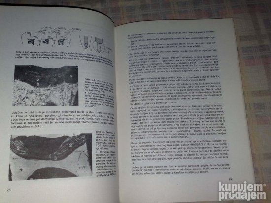 Endodoncija Patologija i Terapija-Lecenje,Ablacija pulpe,
