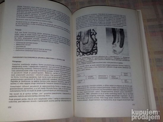 Endodoncija Patologija i Terapija-Lecenje,Ablacija pulpe,