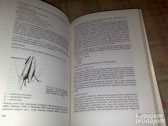 Endodoncija Patologija i Terapija-Lecenje,Ablacija pulpe,